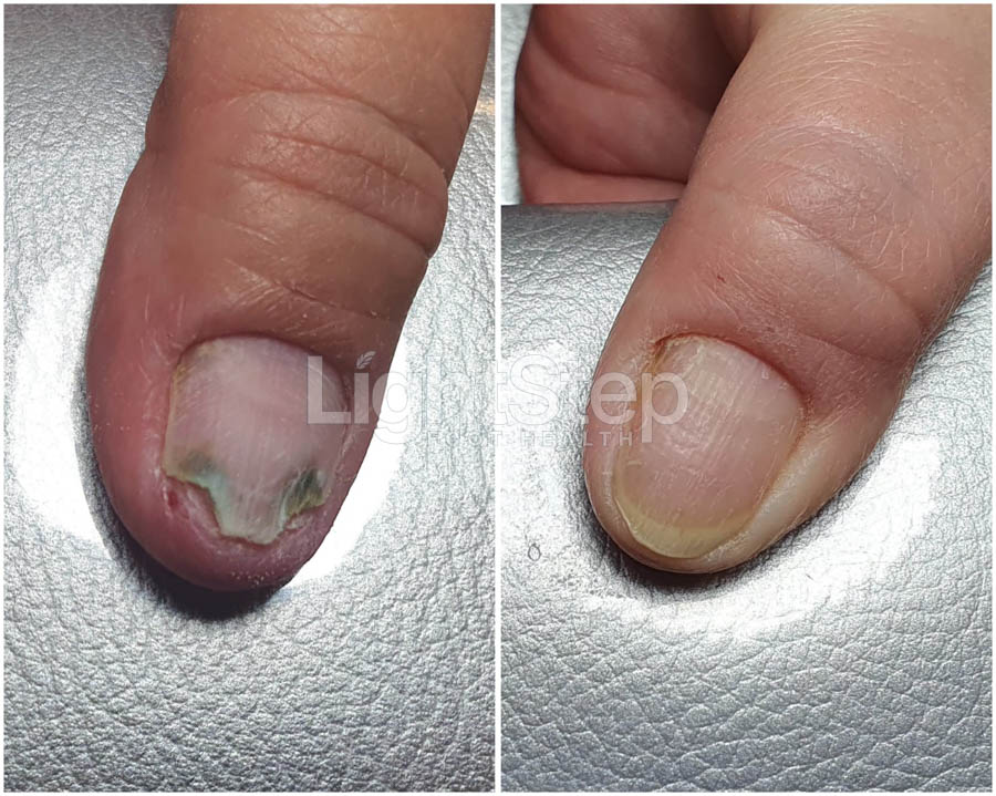 Fungal nail treatment - LightStep Loughborough