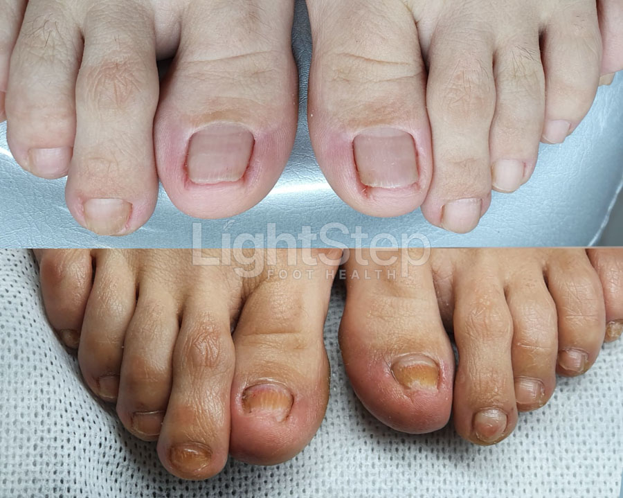 Fungal nail treatment before - LightStep Loughborough